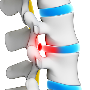 Herniated or Bulging Discs